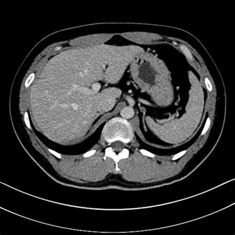 Adrenal Gland Anatomy Ct