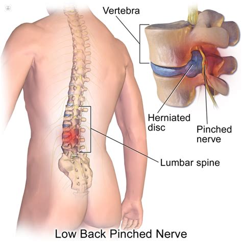 Slipped disc: what is it, symptoms and treatment | Top Doctors