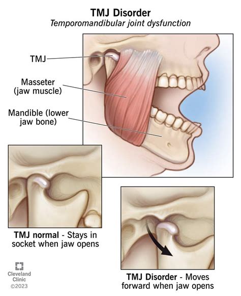 TMJ Disorders: Symptoms, Causes & Treatment