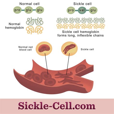 What Causes Sickle Cell Disease?