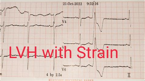 Hypertension || Left Ventricular Hypertrophy with Strain on ECG Strip ...