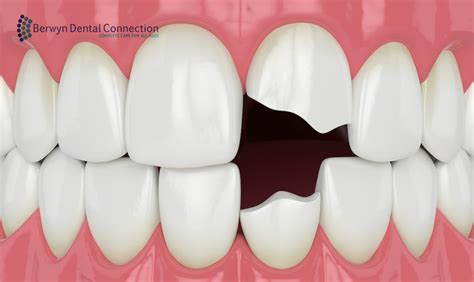 How to save a knocked-out tooth? | Berwyn Dental Connection