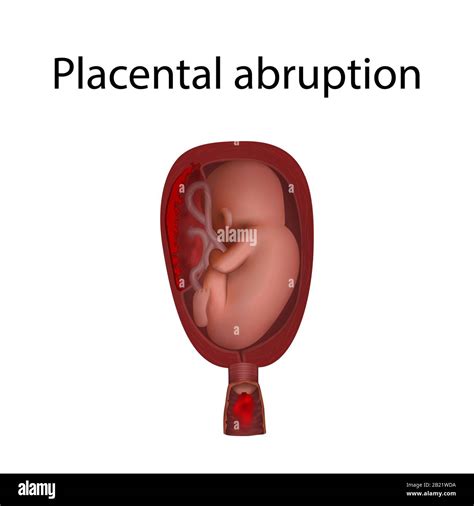 Placental abruption hi-res stock photography and images - Alamy