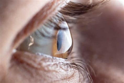 Astigmatism: Causes, Symptoms, and Treatment | BDP Lasik