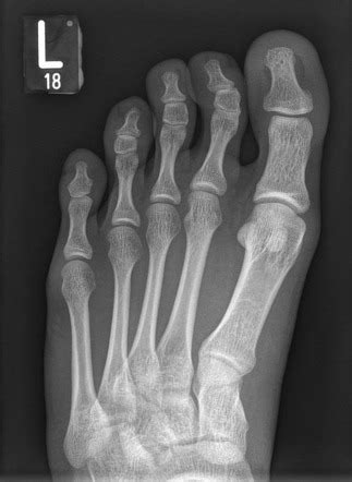 Normal toe series | Radiology Case | Radiopaedia.org