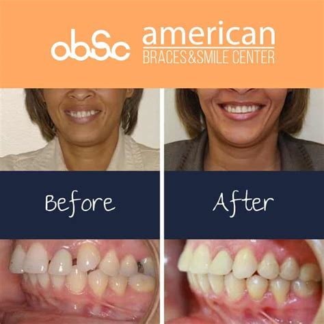 Braces Under Bite Adult Before And After