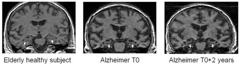 17: Coronal slices of T1 weighted MRI, showing the atrophy of the ...