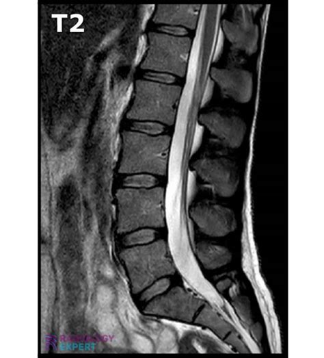 MRI Lumbar Spine