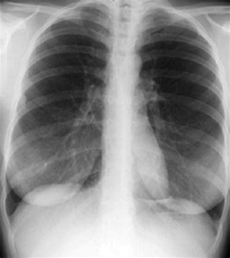 New X-Ray Approach May Permit Early Detection of Severe Lung Diseases ...