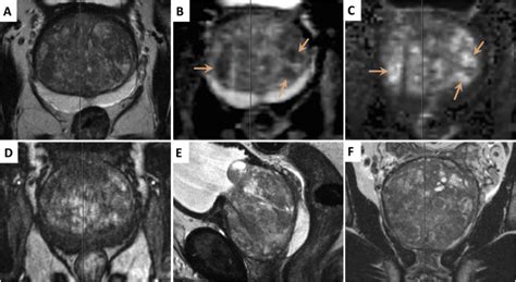 Prostate Gland Anatomy Mri