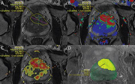 Prostate Cancer Diagnosis Improves with MRI Technology