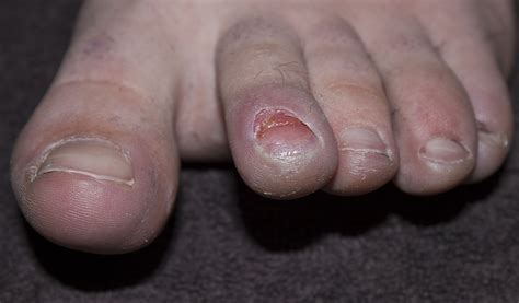 Subungual Hematoma: How to treat a bruised toenail at home - Daily Medicos