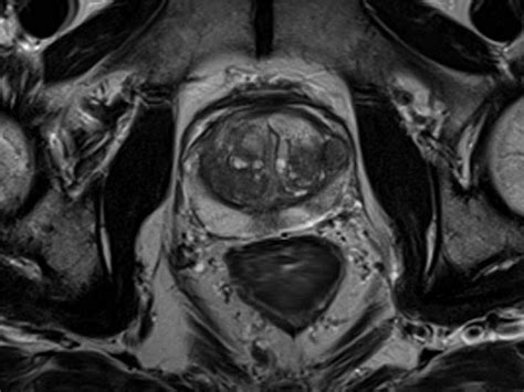 Prostate MRI - Siemens Healthineers USA