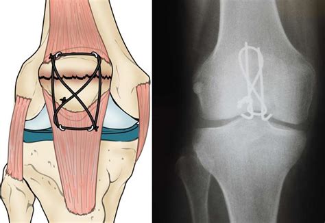 Patellar Fractures (Broken Kneecap) - OrthoInfo - AAOS