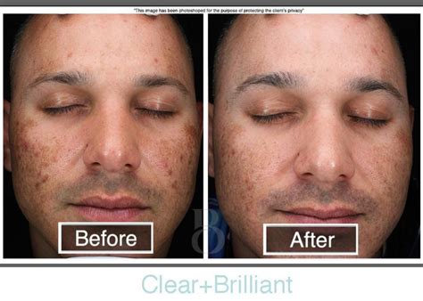 Clear + Brilliant - Miami, FL: Brickell Cosmetic Center