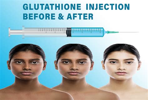 Glutathione Injection Before And After