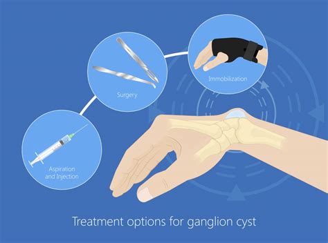 Ganglion Cyst Removal, 48% OFF | www.elevate.in