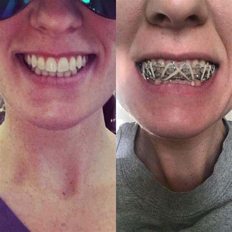 Both pics taken this morning...before and after my braces were removed ...