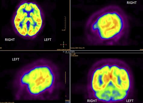 How a PET Scan Can Diagnose Lung Cancer