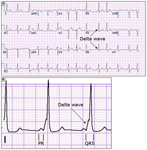 delta wave ecg