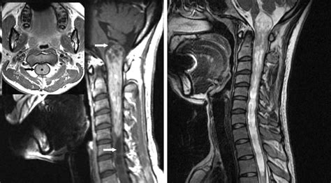 Intramedullary Spinal Cord Tumor | The Neurosurgical Atlas