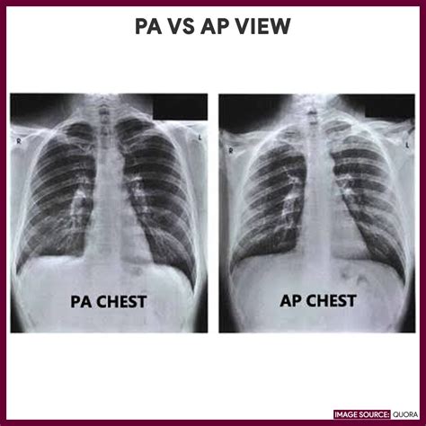 Pa And Lateral Chest X Ray