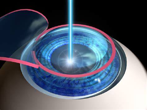 What Are The Different Types of Laser Eye Surgery? | Universal Health Care