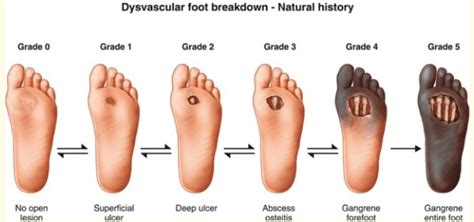 Diabetic Foot Sores: Peachstate Advanced Cardiac & Endovascular: Board ...