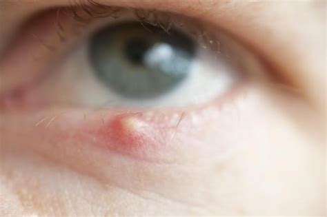 Eye Stye - Causes, Symptoms, Treatment, Pictures | Stye Eye | Stye in ...