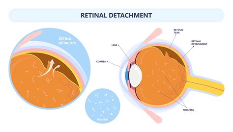 Retinal Tear Cincinnati | Retinal Detachment Florence, KY