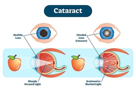 Cataract Prevention - Cataract Causes - Cataract Symptoms