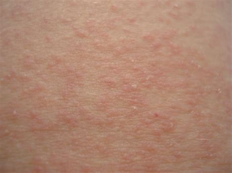 Sweat Rash - Pictures, Causes and How to get rid of It