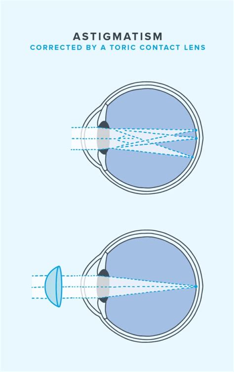 What Are Toric Contact Lenses? | Warby Parker