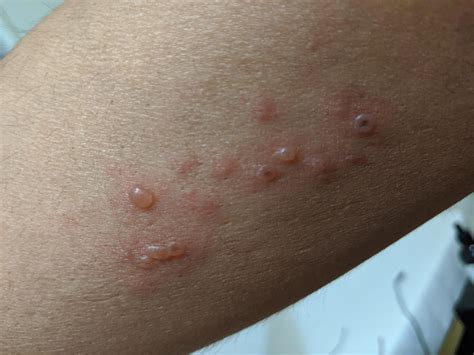 is this spider bite, should I go to Doctors...4 days old : r/spiderbites