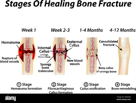 Stages Of Healing Bone Fracture. Formation of callus. The bone fracture ...