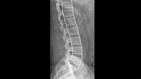 Lumbar X-ray Interpretation - OSCE Guide | Radiology | Geeky Medics