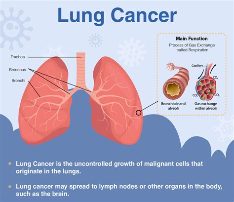 Lung Cancer Symptoms Causes Types Diagnose And Treatments – NBKomputer