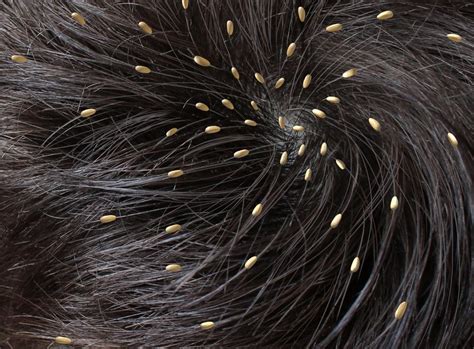 Head lice: Causes, symptoms, and treatments