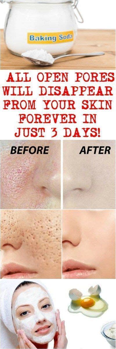 How to Get Rid of Enlarged Pores Naturally - My Favorite Things | Skin ...