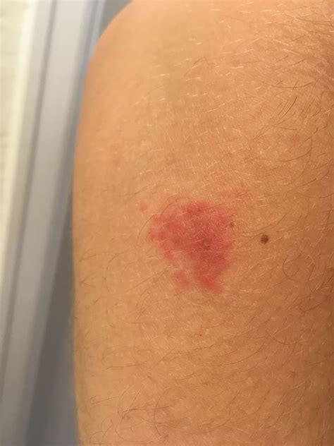 Mysterious itchy spots on my arm