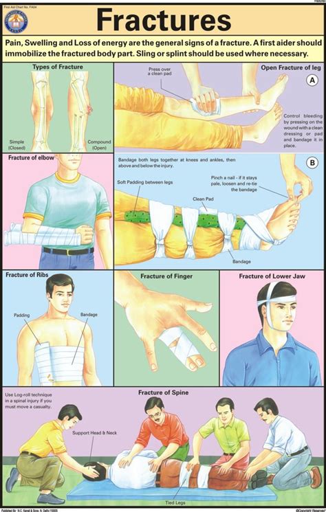 Laminated Paper Fractures For First Aid Chart at Rs 96/piece in New ...