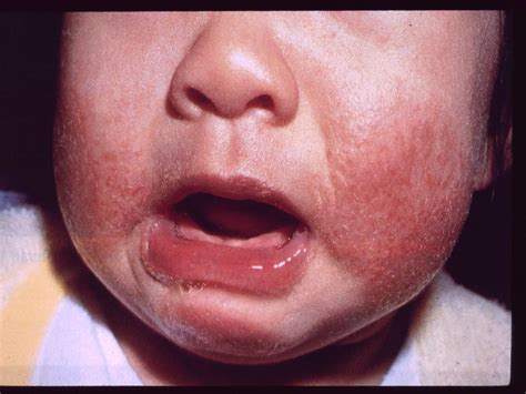 Baby eczema: causes, symptoms, treatment and more