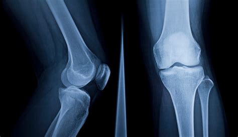 Knee X-Ray: Anatomy, Procedure & What to Expect