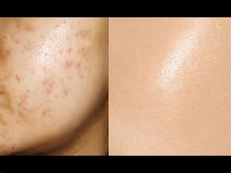 Remove Acne Marks | 3 Step - Natural Remedies for Pimple Marks ...