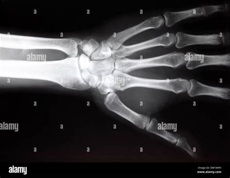 Broken bone xray hi-res stock photography and images - Alamy