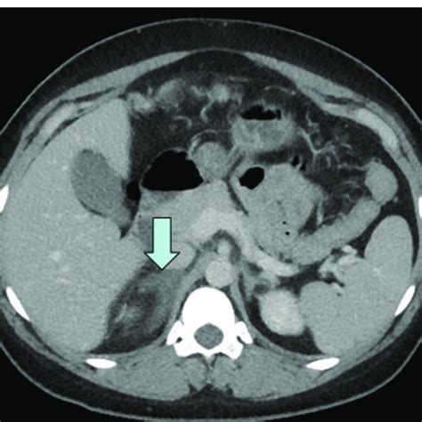 CT scan of patient in Case 1, demonstrating enlargement of the right ...