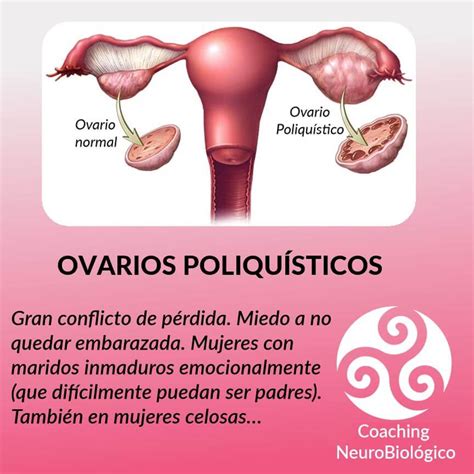 Ovario poliquístico - Coaching de Salud Integral.