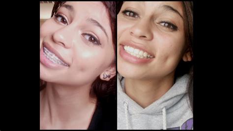 Before And After Braces: Buck Teeth Before And After Braces Pictures