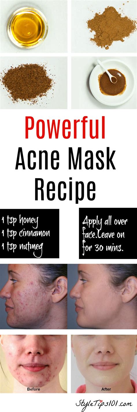 Best 23 Diy Face Masks Acne – Home, Family, Style and Art Ideas