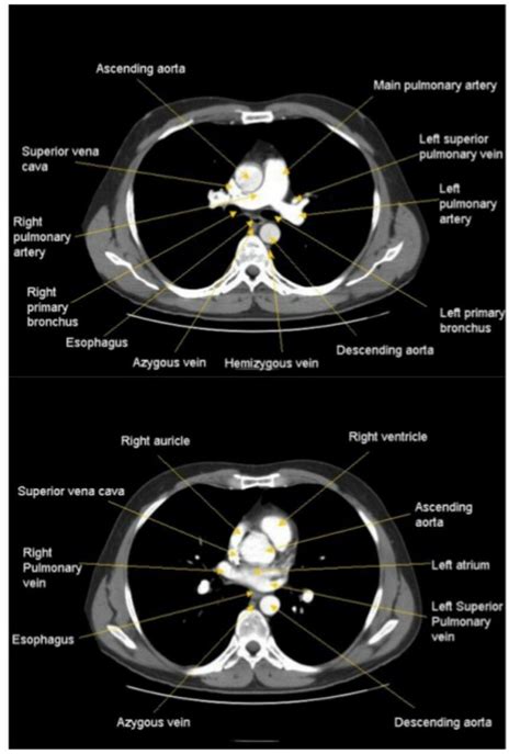 CT Chest Imaging for Radiology Students